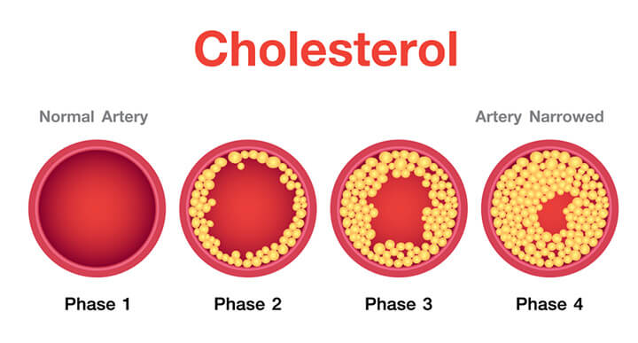 Cholesterol la gi